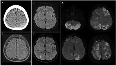 Case Report and Review of the Literature: Fatal Reversible Cerebral Vasoconstriction Syndrome